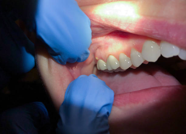 Best Tooth Infection Emergency Dentist  in Thoreau, NM
